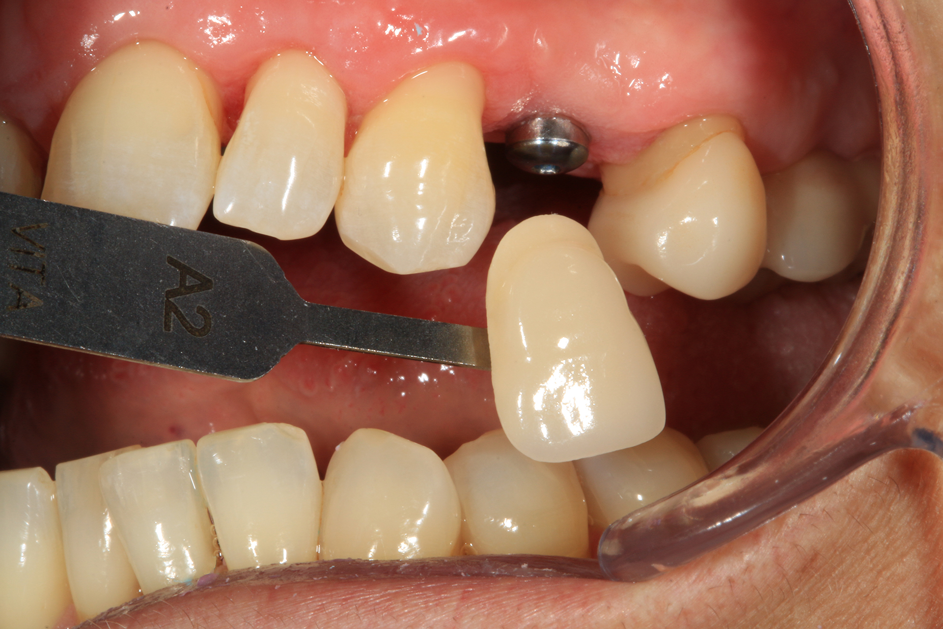 Sopravvivenza di Impianti Core-X®