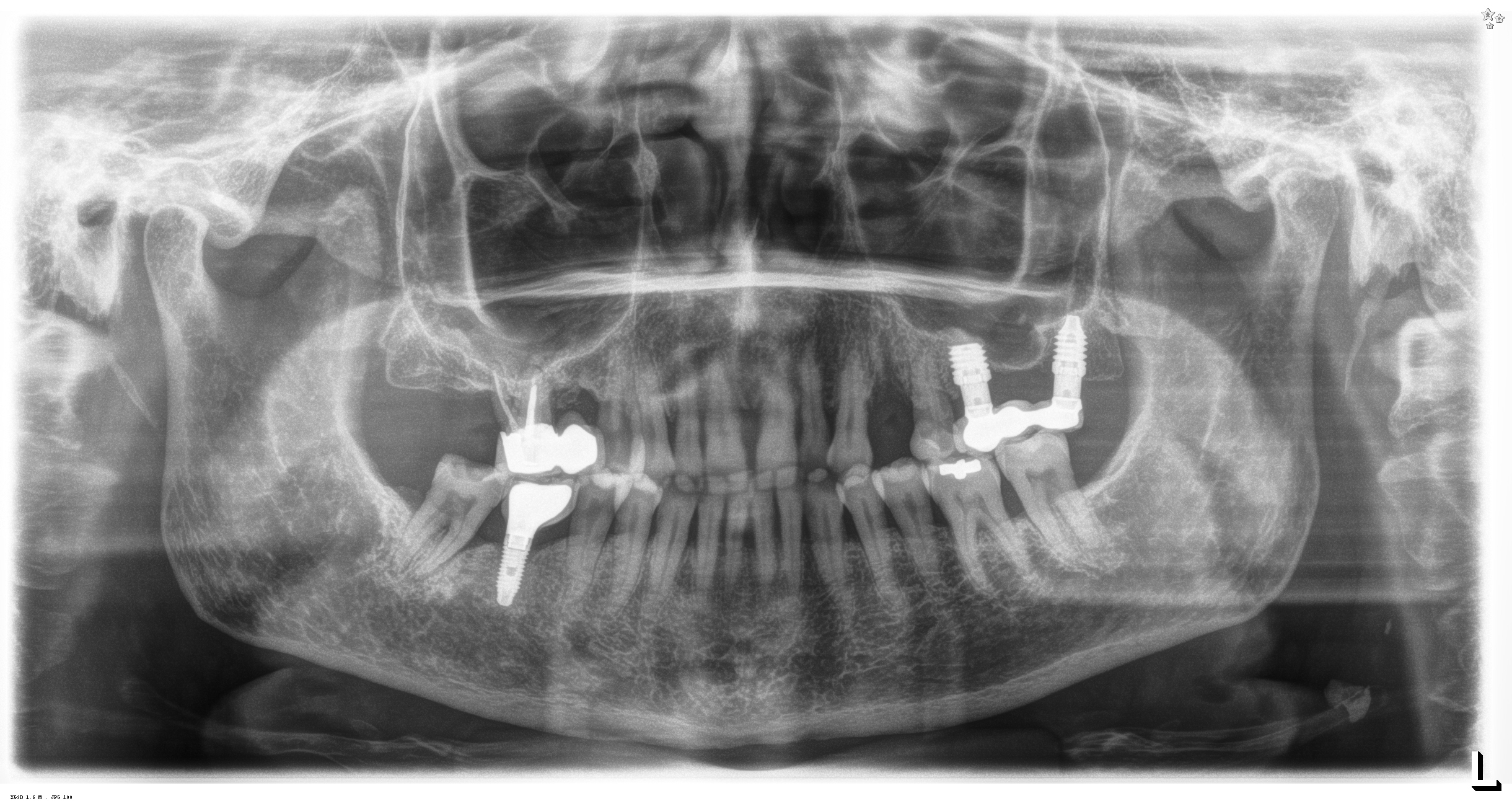 Sopravvivenza di Impianti Core-X®