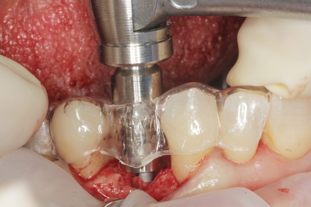 Sopravvivenza di Impianti Core-X®