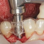 Sopravvivenza di Impianti Core-X® posizionati con chirurgia driver guidata Sopravvivenza di Impianti Core-X®