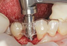 Sopravvivenza di Impianti Core-X® posizionati con chirurgia driver guidata Sopravvivenza di Impianti Core-X®