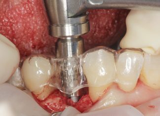 Sopravvivenza di Impianti Core-X® posizionati con chirurgia driver guidata Sopravvivenza di Impianti Core-X®