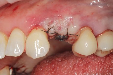 Sopravvivenza di Impianti Core-X®