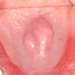 Il laser erbio in chirurgia ossea orale Laser erbio