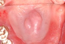 Il laser erbio in chirurgia ossea orale Laser erbio