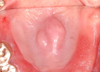 Il laser erbio in chirurgia ossea orale Laser erbio