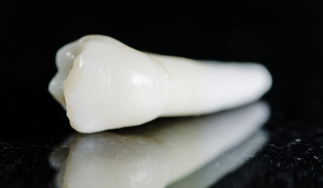 maxillary premolar - extracted teeth Carie radicolare