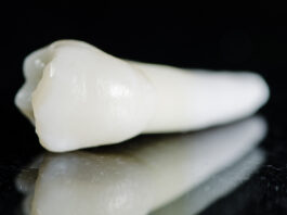 Carie radicolare: l’efficacia di alcuni agenti remineralizzanti in uno studio in vitro Carie radicolare