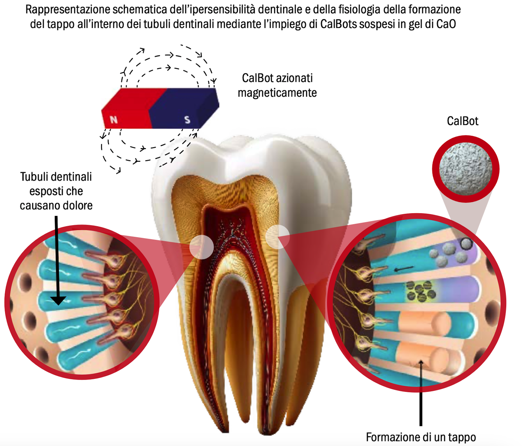 CalBots ipersensibilità dentale