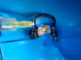 Preparazione canalare endodontica: come ridurre l’estrusione apicale dei detriti Preparazione canalare endodontica