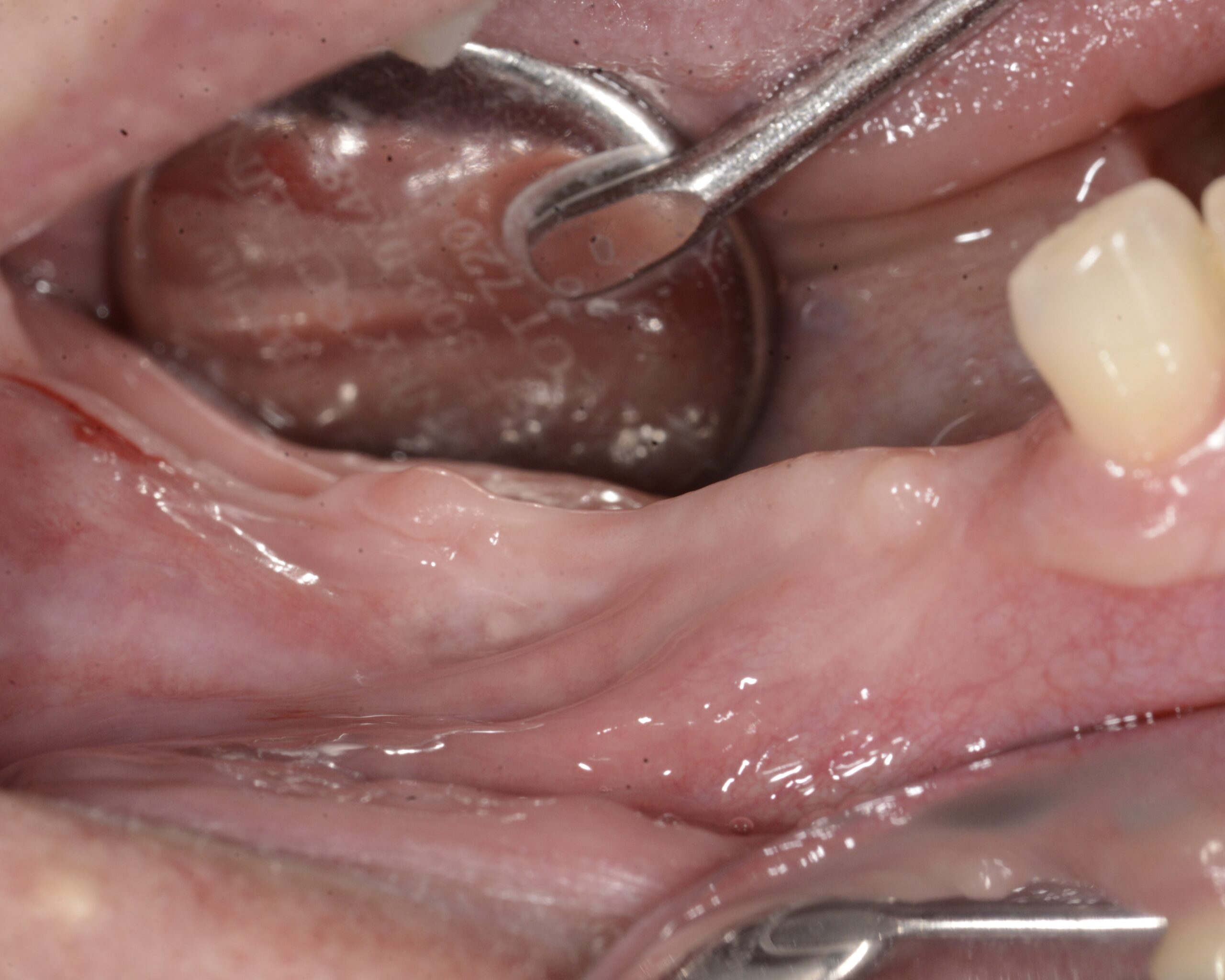 GBR griglia customizzata