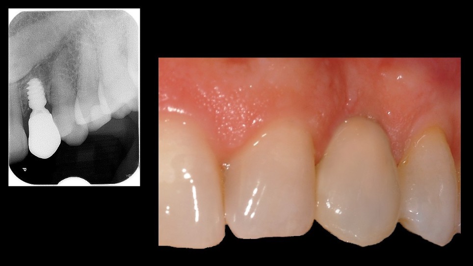 Impianti short e ultra short