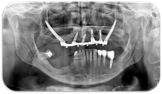 Impianti short e ultrashort