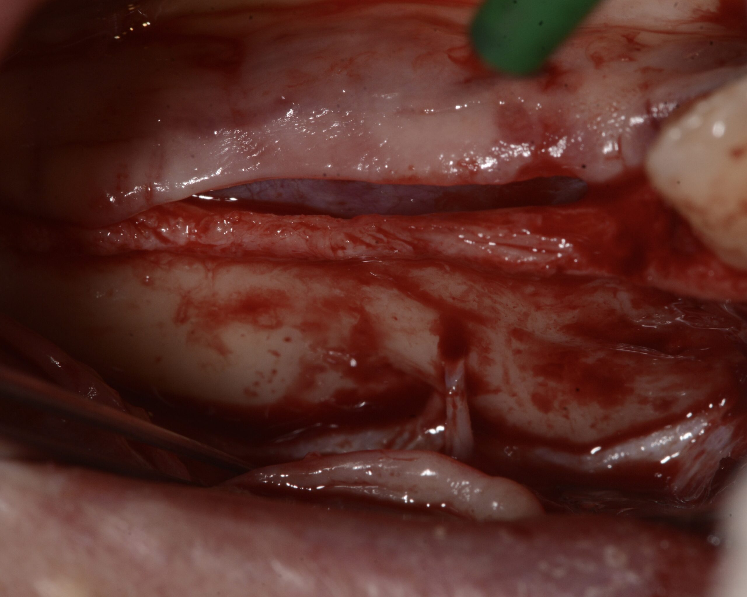 GBR griglia customizzata