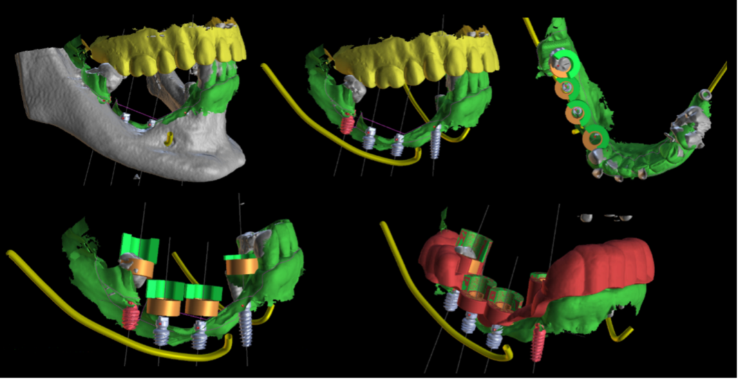 5_Corti Impianti short e ultra short