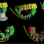 Impianti short e ultra short: basi biologiche, biomeccanica e applicazioni cliniche Impianti short e ultra short