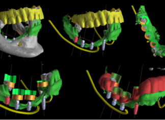 Impianti short e ultra short: basi biologiche, biomeccanica e applicazioni cliniche Impianti short e ultra short