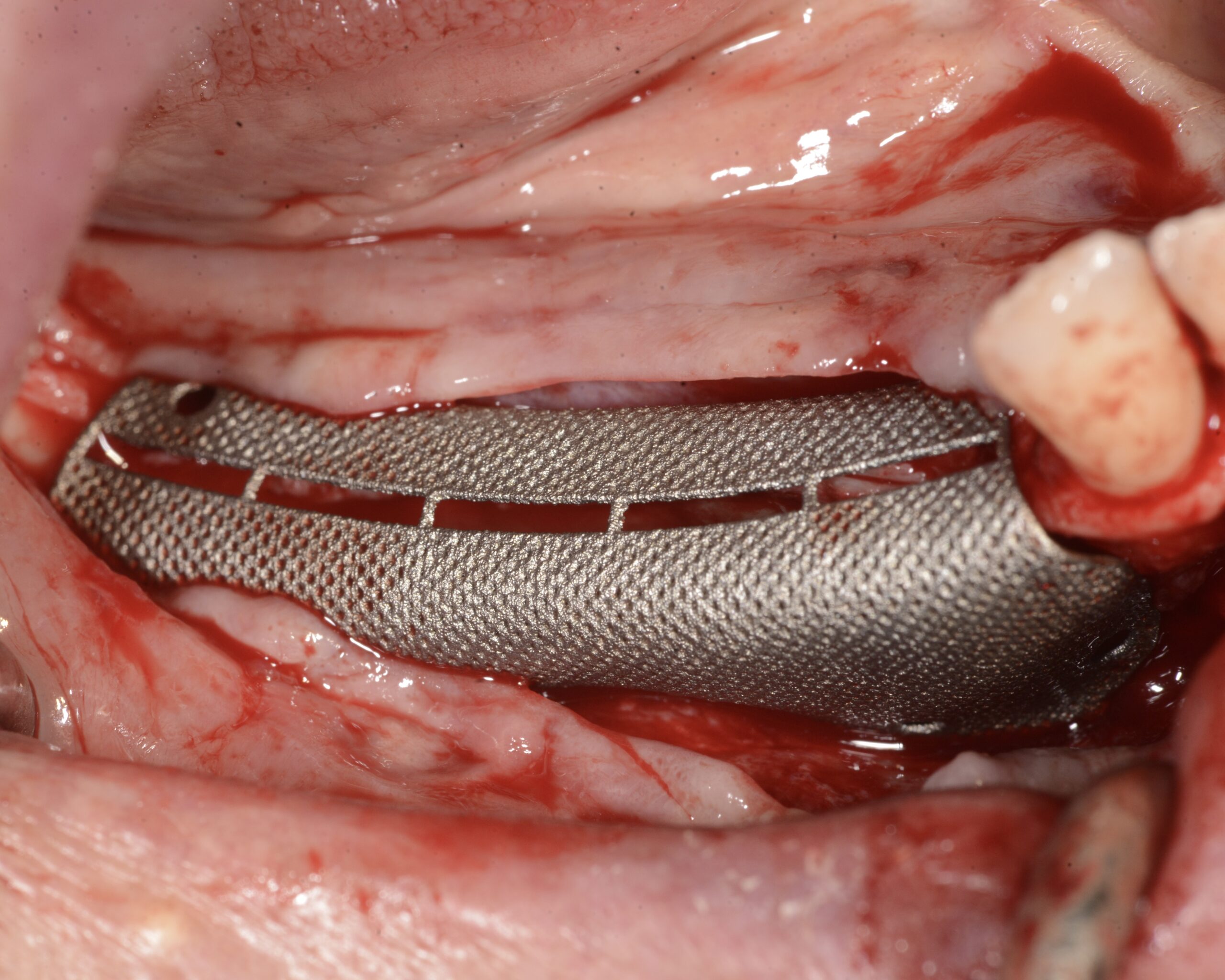 GBR griglia customizzata