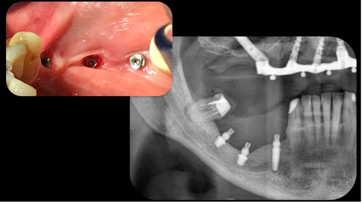 Impianti short e ultrashort