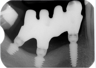 Impianti short e ultra short