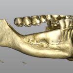 GBR con griglia customizzata in mandibola atrofica GBR griglia customizzata