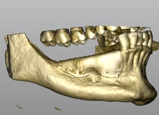 GBR con griglia customizzata in mandibola atrofica GBR griglia customizzata
