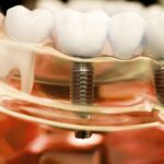 Tessuti molli peri-implantari: una priorità clinica tessuti molli peri-implantari