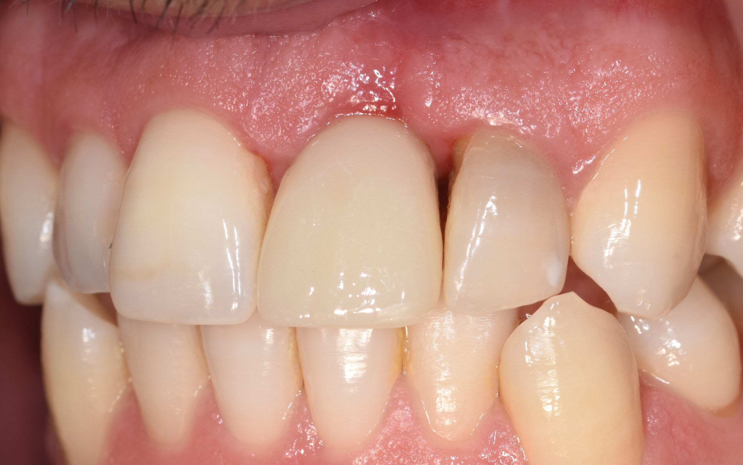 profilo tissutale impianto post-estrattivo