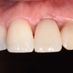 Mantenimento del profilo tissutale nell’impianto post-estrattivo ritardato: obiettivo realistico?