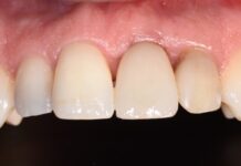 Mantenimento del profilo tissutale nell’impianto post-estrattivo ritardato: obiettivo realistico?