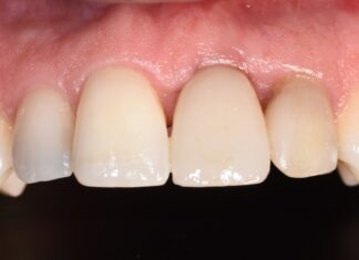 Mantenimento del profilo tissutale nell’impianto post-estrattivo ritardato: obiettivo realistico?