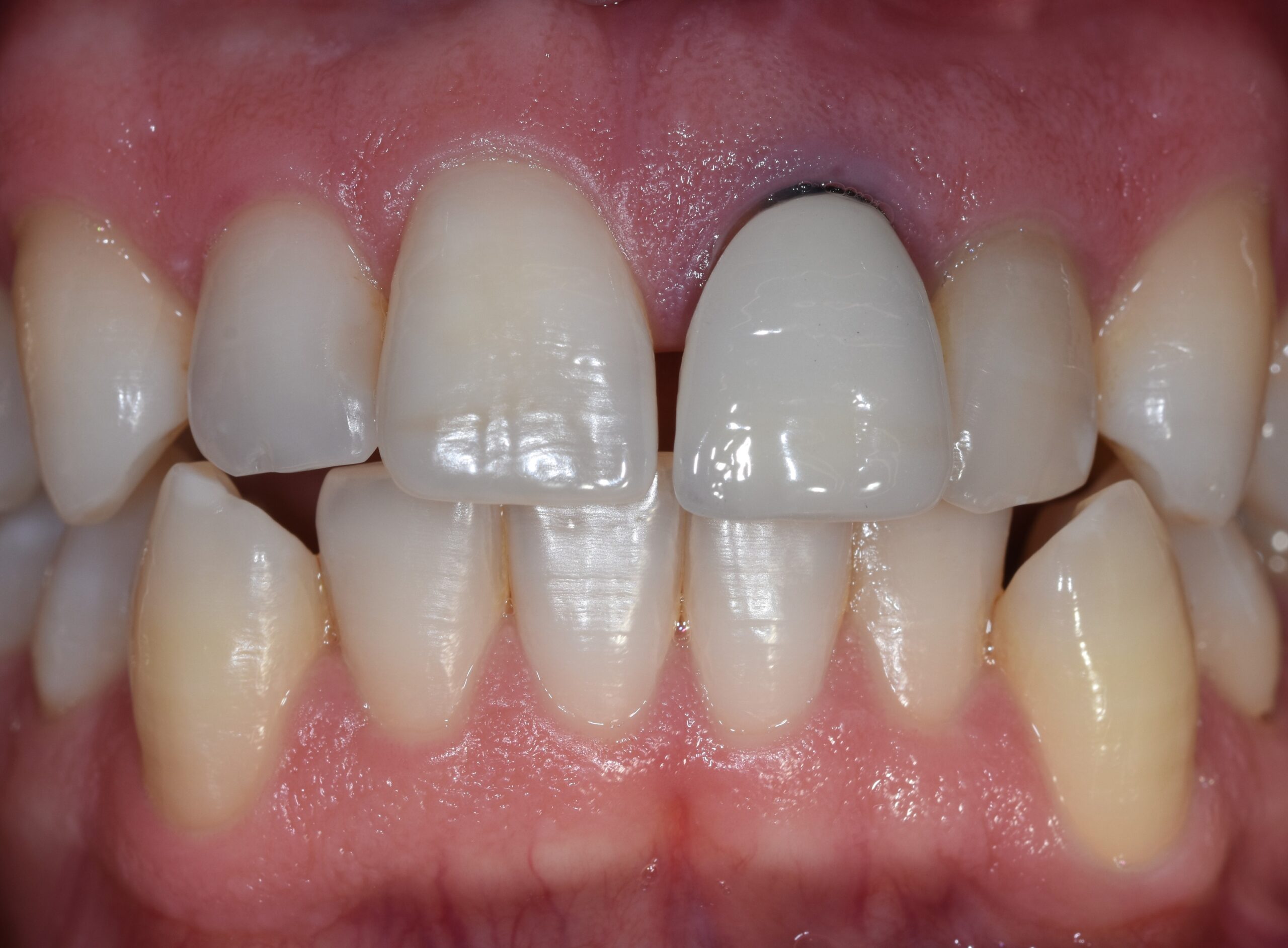 profilo tissutale impianto post-estrattivo