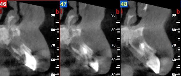 profilo tissutale impianto post-estrattivo