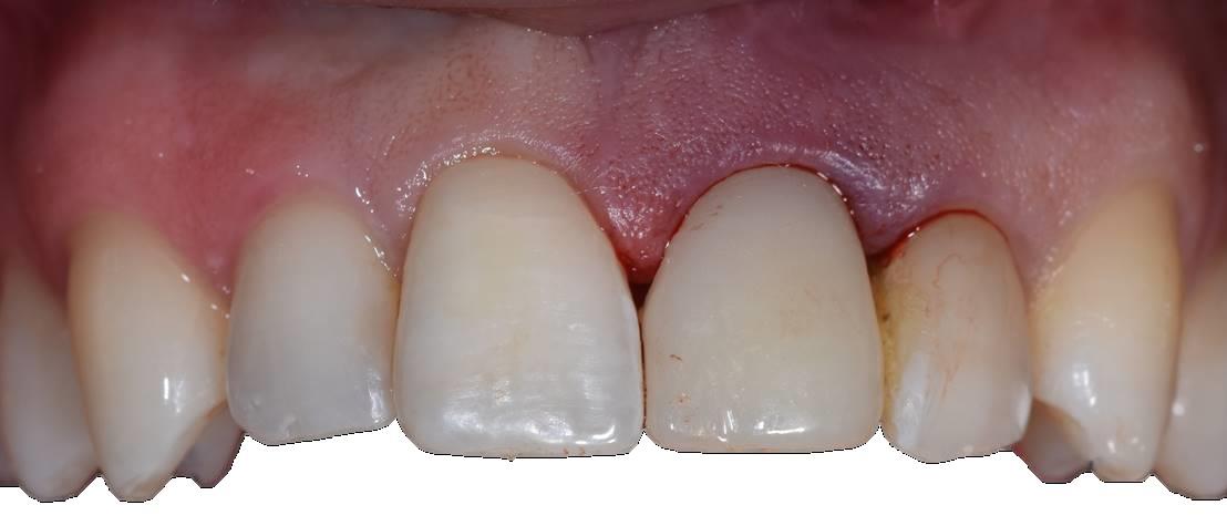 profilo tissutale impianto post-estrattivo