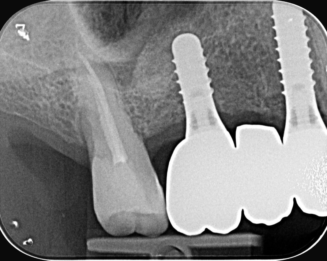 Riabilitazione implantare mascellare