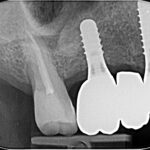 Riabilitazione implantare mascellare e rialzo transcrestale con tecnica sonica Riabilitazione implantare mascellare