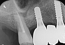 Riabilitazione implantare mascellare e rialzo transcrestale con tecnica sonica Riabilitazione implantare mascellare