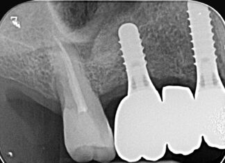 Riabilitazione implantare mascellare e rialzo transcrestale con tecnica sonica Riabilitazione implantare mascellare