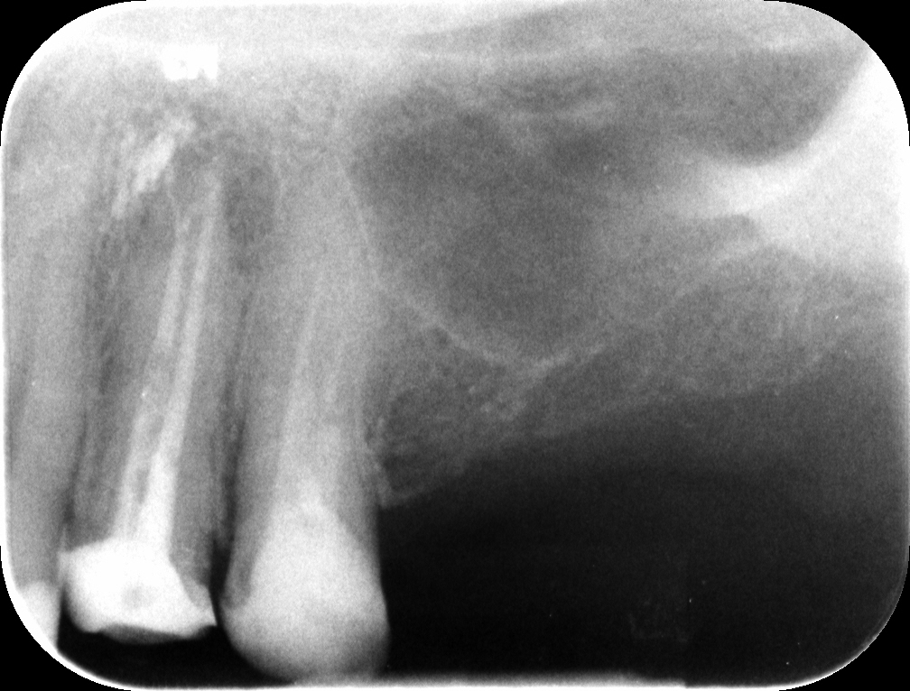 Ritrattamento canalare