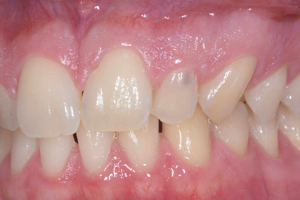 Riassorbimento cervicale esterno