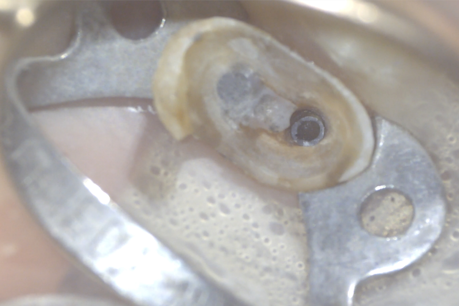 Ritrattamento canalare