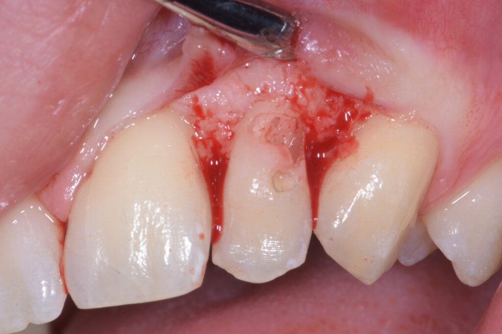 Riassorbimento cervicale esterno 