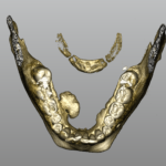 Rimozione di esteso torus mandibolare con tecnica piezoelettrica