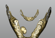 Rimozione di esteso torus mandibolare con tecnica piezoelettrica