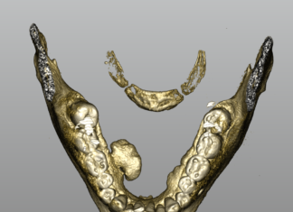 Rimozione di esteso torus mandibolare con tecnica piezoelettrica