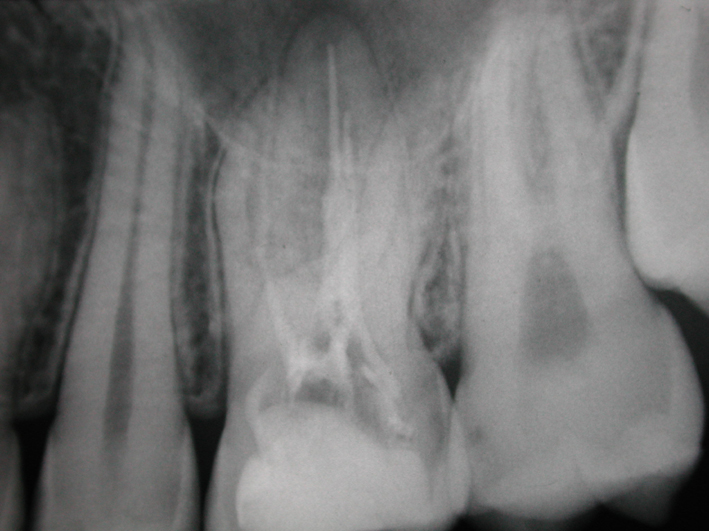Riassorbibenti radicolari