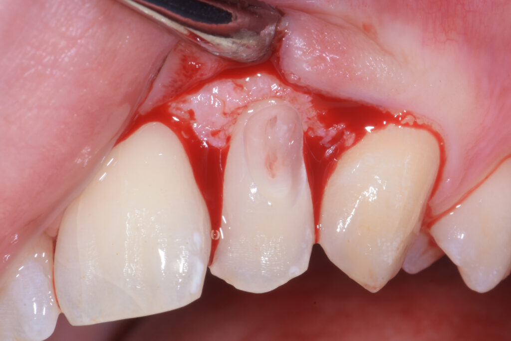 Riassorbimento cervicale esterno