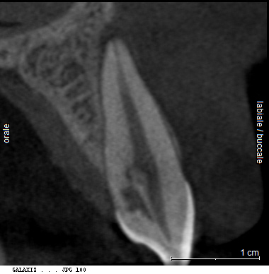 riassorbimenti radicolari