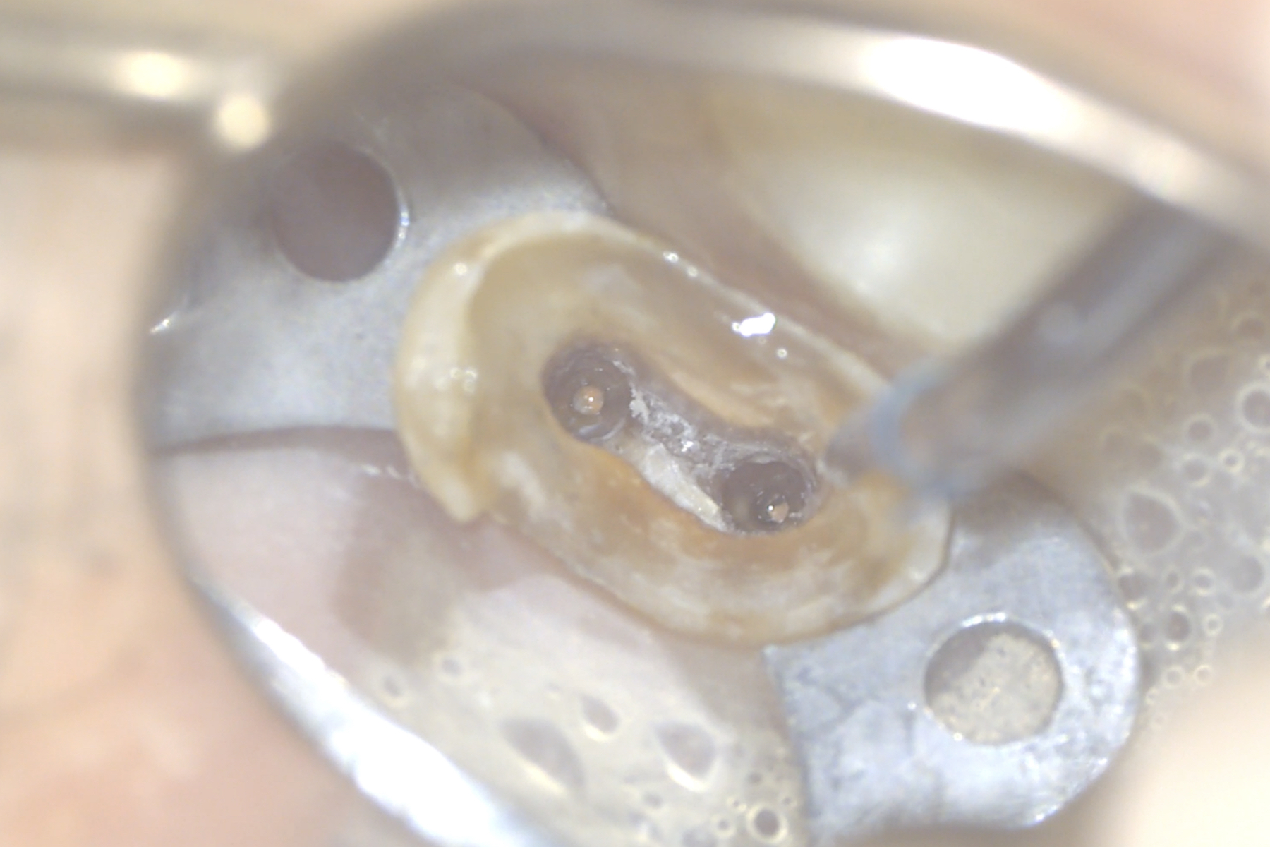 Ritrattamento canalare