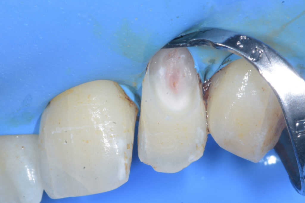 Riassorbimento cervicale esterno